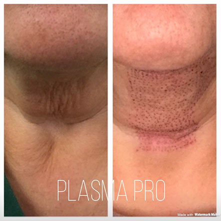 Daffodil plasma pro facelifts