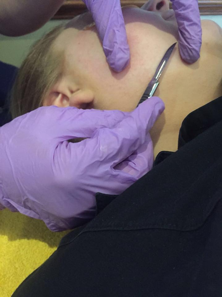 dermaplaning 1